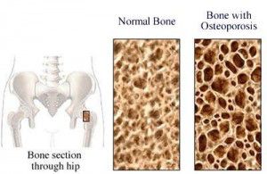 osteoporosis awareness and prevention