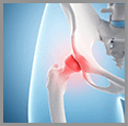 Hip Fracture Care & Recovery
