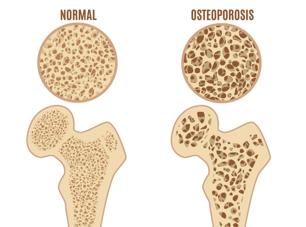 Osteoporosis Image