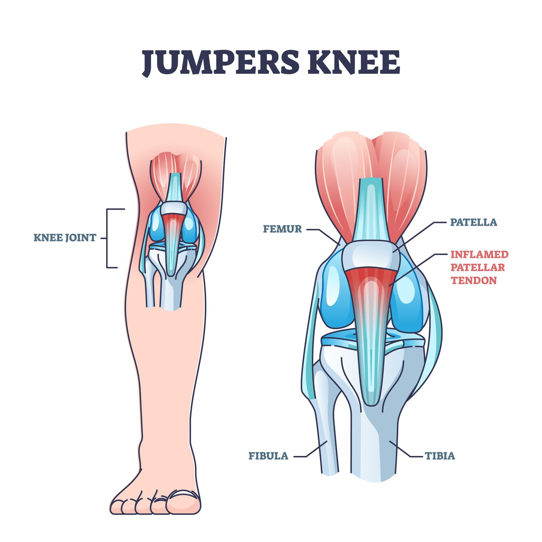 Patellar Tendon Jumpers Knee 
