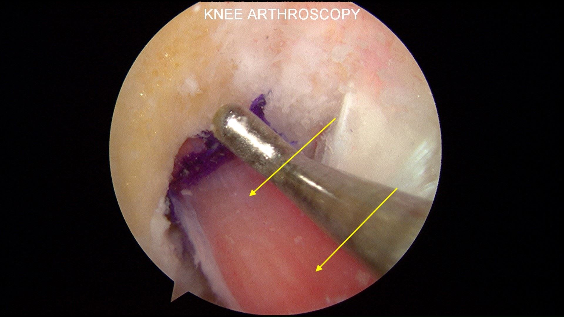 After reconstruction with patellar tendon