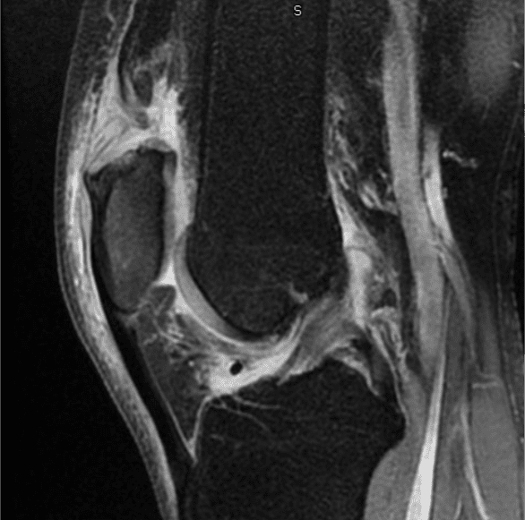 MRI of a quadriceps tendon rupture