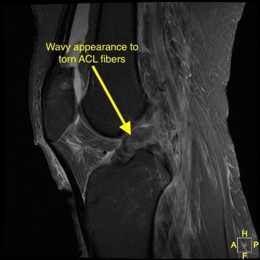 MRI of a. ACL rupture