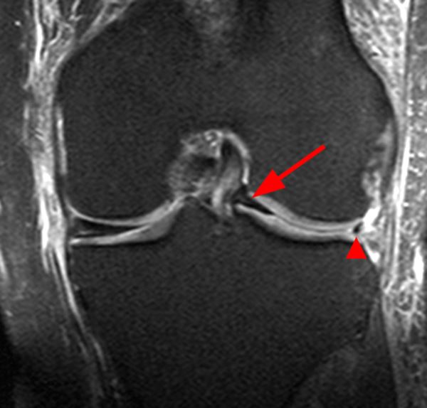 Meniscal Tear Patterns - Radsource