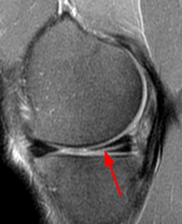 Meniscal Tear Patterns - Radsource