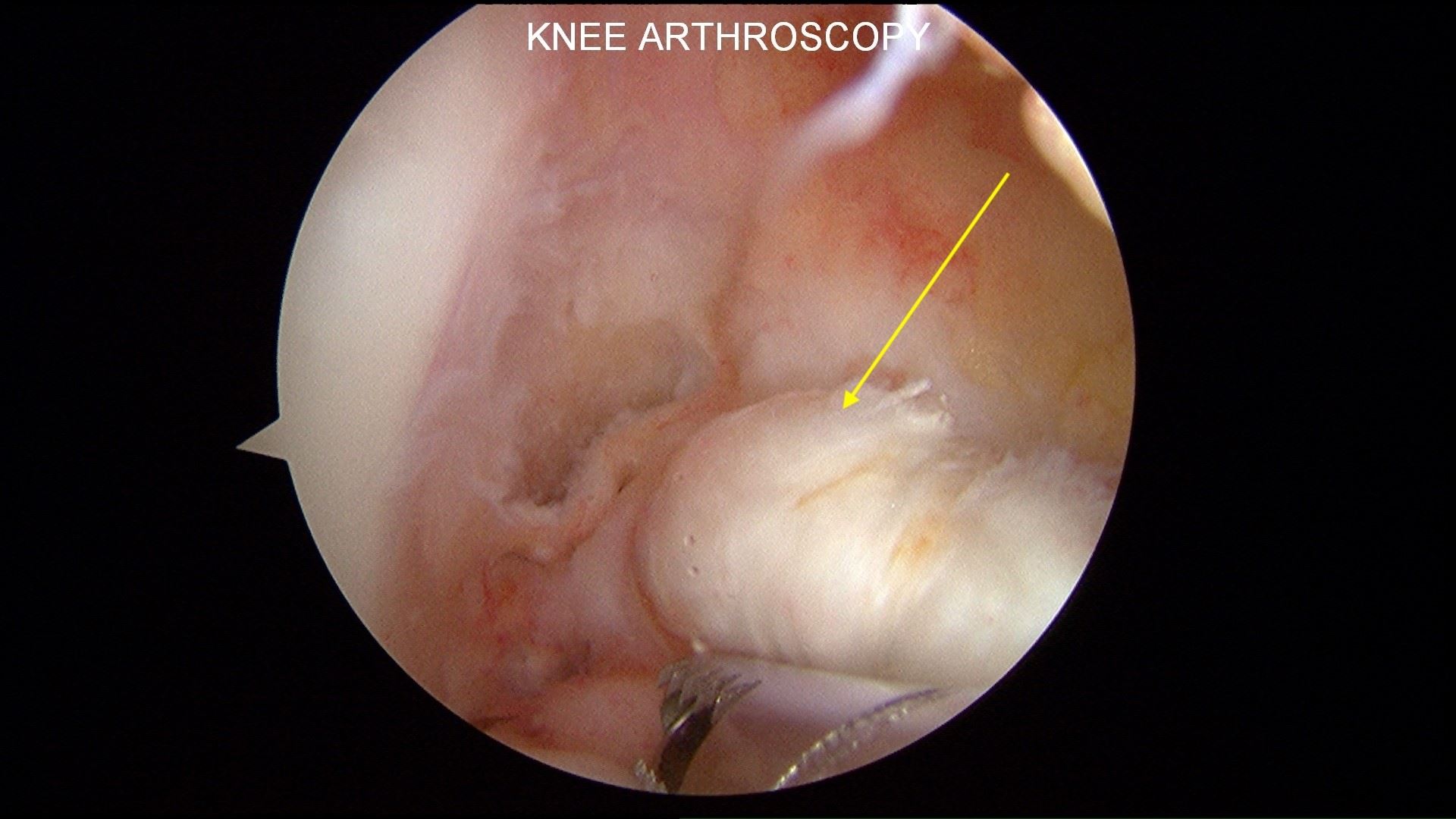 Torn ACL fibers