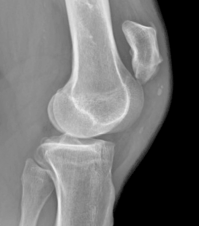  X-ray demonstrating patella alta due to patellar tendon rupture