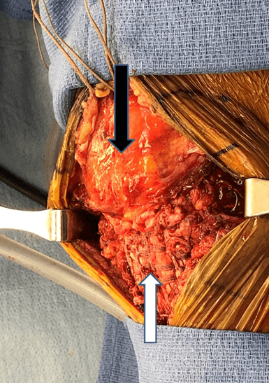 Patellar Tendon Repair 