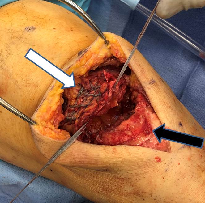 Quadriceps Tendon Repair 