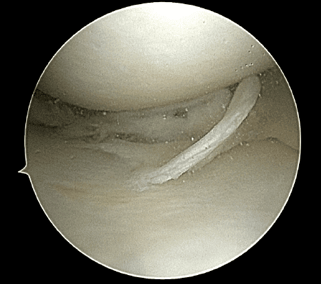 meniscus tear image 