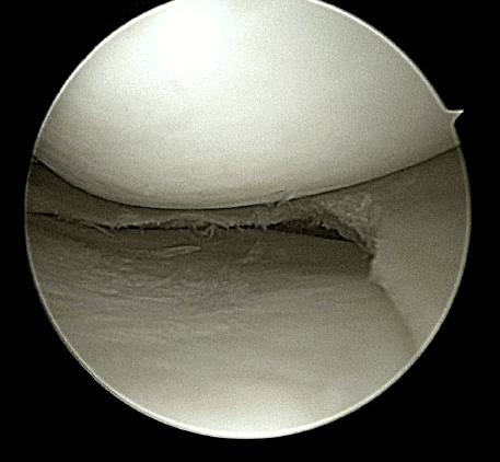 meniscus tear image 