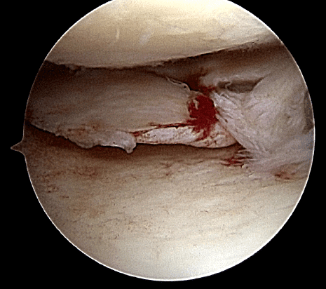 meniscus tear image 
