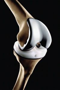 knee replacement 